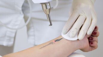 Auch beim Entfernen von Tattoos kann es zu Komplikationen kommen
