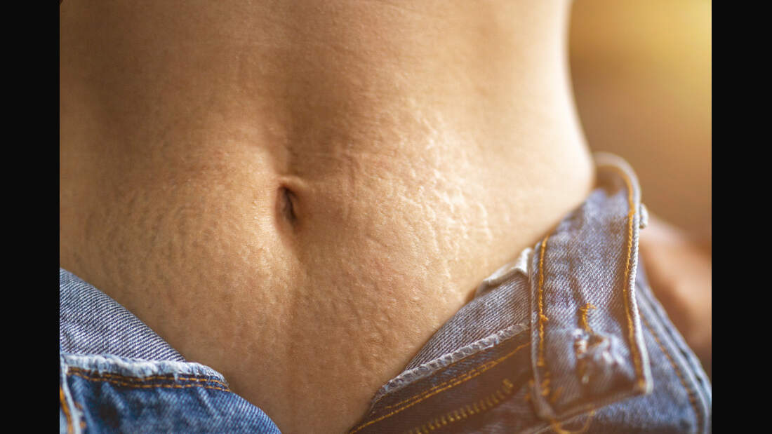 Dehnungsstreifen: Tipps, um sie loszuwerden | Womens Health Dehnungsstreifen: Tipps, um sie loszuwerden | Womens Health