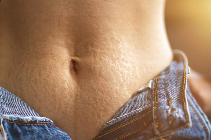 Dehnungsstreifen Tipps Um Sie Loszuwerden Women S Health