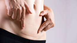 Eine Kaiserschnittnarbe braucht etwa ein Jahr um zu verblassen