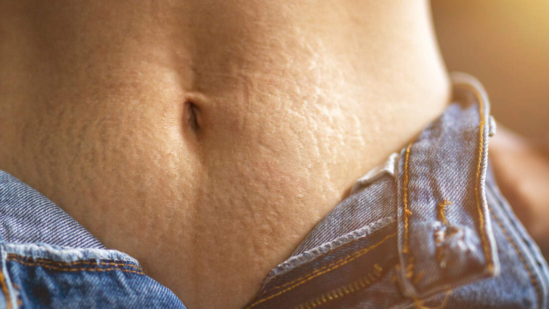 Dehnungsstreifen: Tipps, um sie loszuwerden | WOMEN'S HEALTH